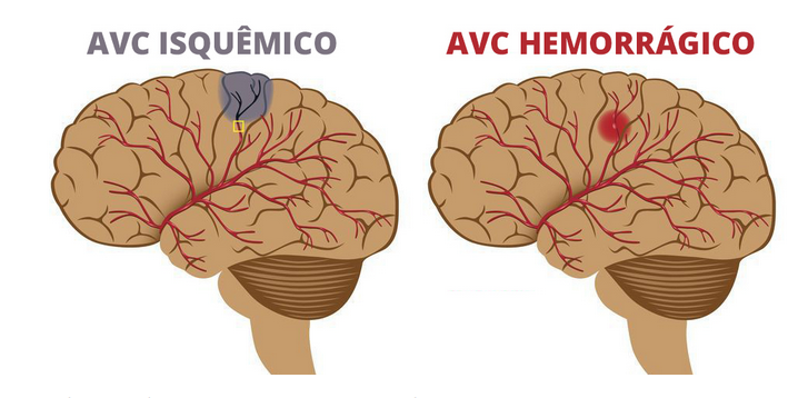 O que é o acidente vascular cerebral?