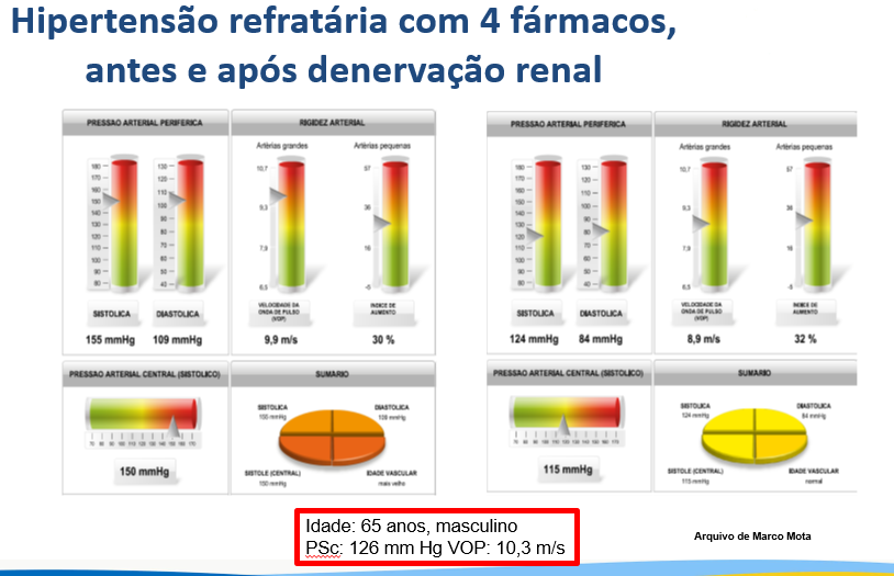 Artigo sobre PRESSÃO CENTRAL, VOP e Alx publicado no jornal O ESTETO DA AMNI Artigo sobre PRESSÃO CENTRAL, VOP e Alx publicado no jornal O ESTETO DA AMNI
